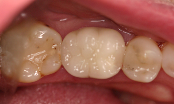 Crowns