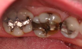 Crowns