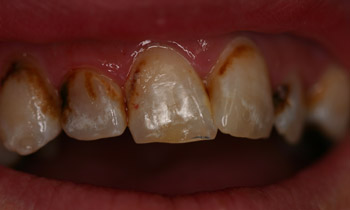 Crowns
