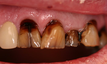 Crowns