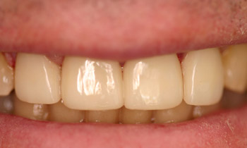 Crowns