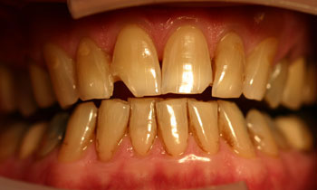 Crowns