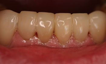 Crowns