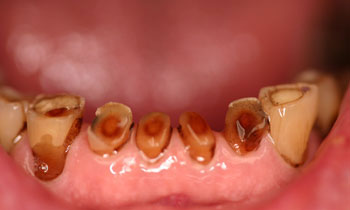 Crowns