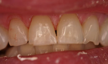 Crowns