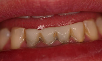 Crowns