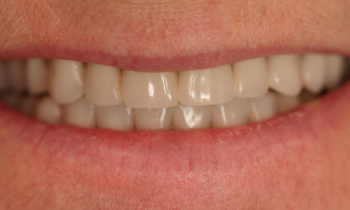 Dentures