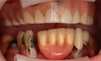 Dentures