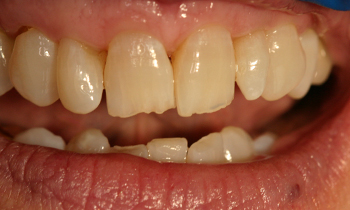 Bonded Fillings