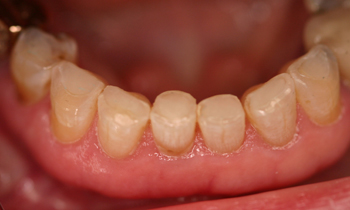 Bonded Fillings