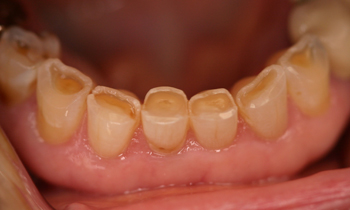 Bonded Fillings