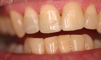 Bonded Fillings
