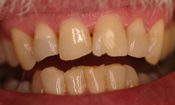 Bonded Fillings