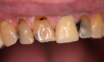 Bonded Fillings