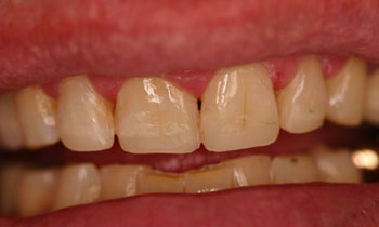 Bonded Fillings