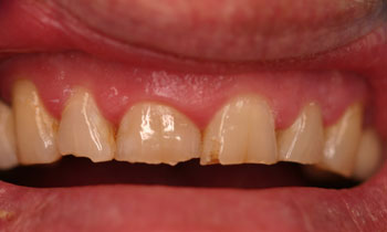 Bonded Fillings