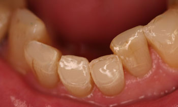 Bonded Fillings