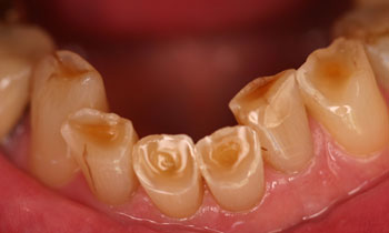 Bonded Fillings
