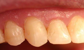 Bonded Fillings