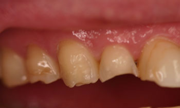 Bonded Fillings