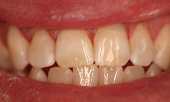 Bonded Fillings
