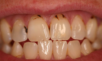 Bonded Fillings