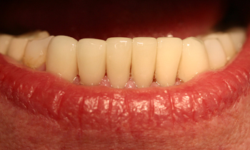 Porcelain Veneers