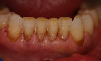 Porcelain Veneers