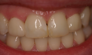 Porcelain Veneers