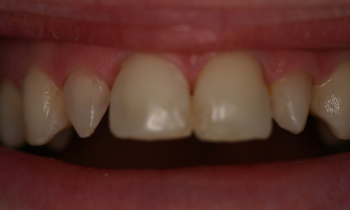Porcelain Veneers