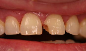 Crowns
