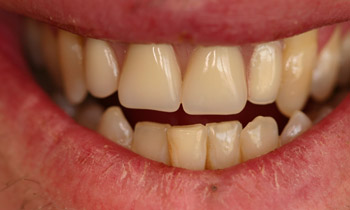 Dentures