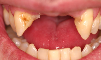 Dentures
