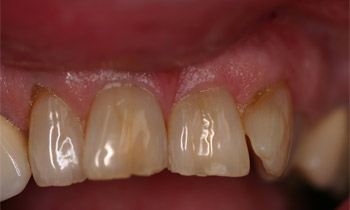 Crowns